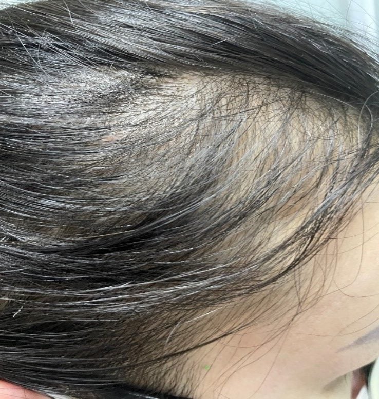 Rụng tóc nhiều là bệnh gì Nguyên nhân và cách trị rụng tóc tại nhà