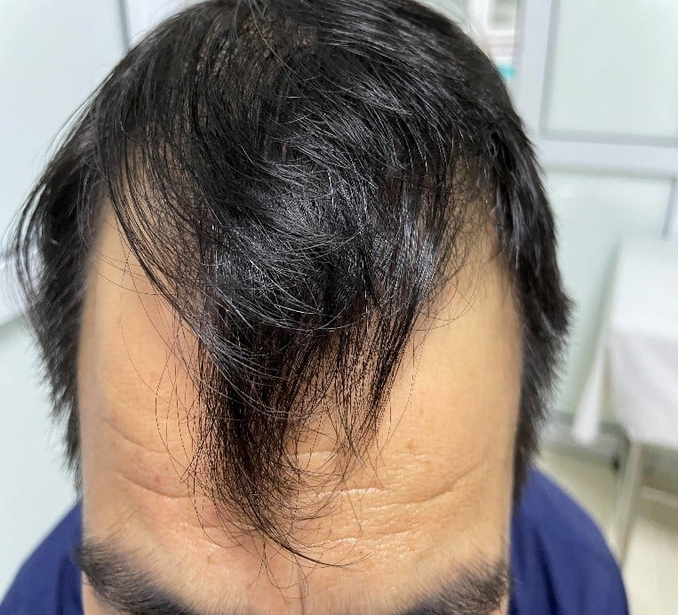 Rụng tóc ở nam tuổi 20: Nguyên nhân và cách khắc phục | Phòng khám Da liễu  thẩm mỹ Bác sỹ Thái Hà