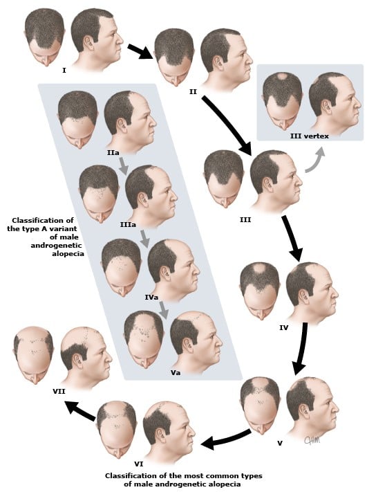Dấu hiệu rụng tóc do nội tiết tố nam và cách khắc phục