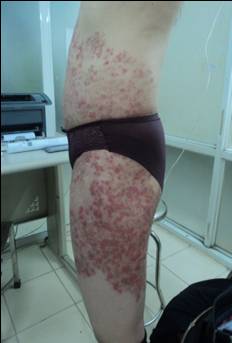 Bệnh nấm da sau bôi steroid (Tinea incognito)