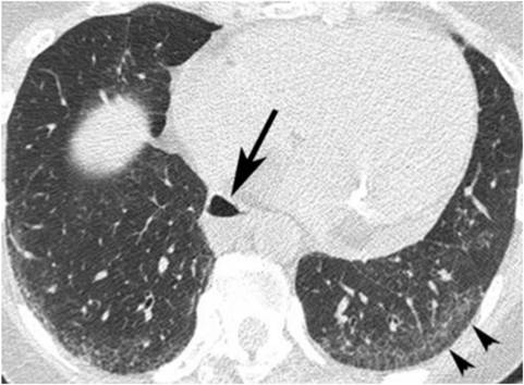  SSc-ILD trên HRCT (Nguồn: Ahuja J., Arora D., Kanne J.P., et al. (2016). Imaging of Pulmonary Manifestations of Connective Tissue Diseases. Radiol Clin North Am, 54, 1015-1031)