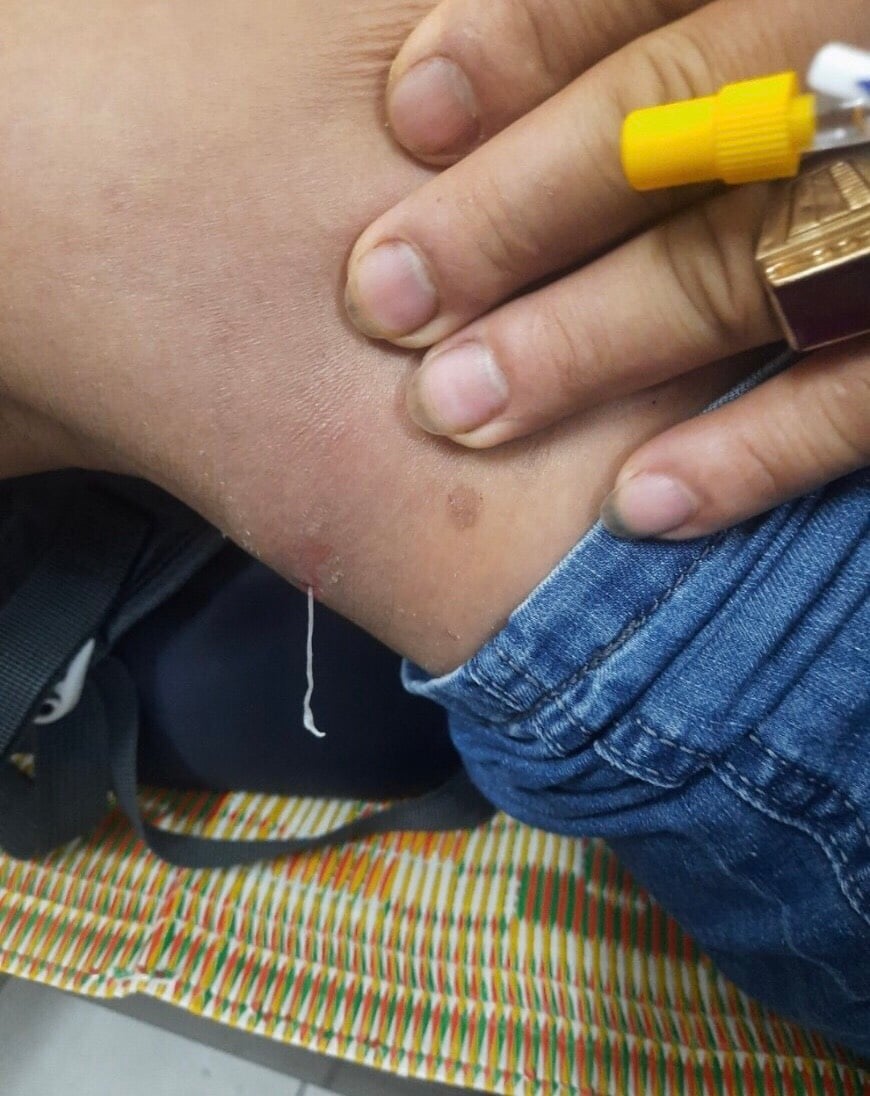https://soyte.yenbai.gov.vn/ContentFiles/FCKEditor/thuky.syt/image/Thang%202_2023/H%C3%ACnh%20%E1%BA%A3nh%20giun%201%20ph%E1%BA%A7n%203%20d%C6%B0%E1%BB%9Bi%20%C4%91%C3%B9i%20ph%E1%BA%A3i%20b%E1%BB%87nh%20nh%C3%A2n.jpg