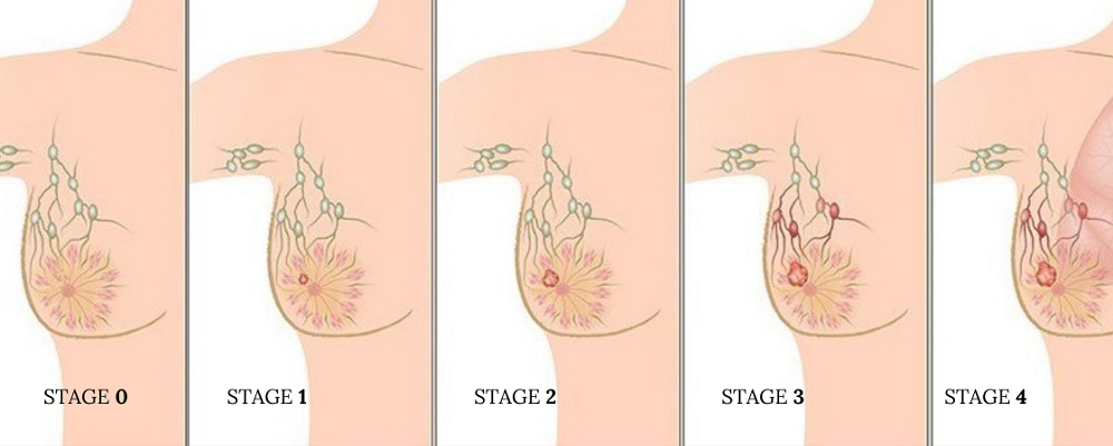 Những điều cần biết về các giai đoạn ung thư vú- Ảnh 3.