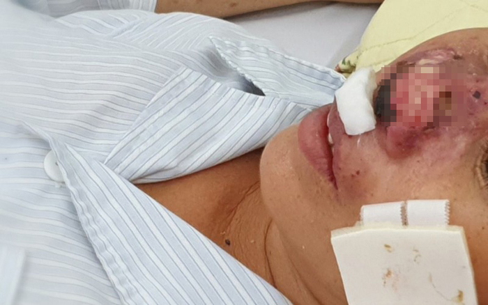 Một bệnh nhân mắc bệnh Whitmore khá hy hữu, với trình trạng vi khuẩn “ăn” cánh mũi được điều trị tại Trung tâm Bệnh Nhiệt đới, Bệnh viện Bạch Mai.
