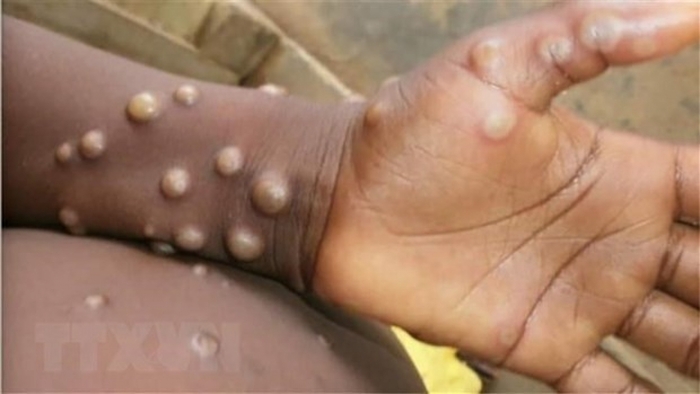 Các phần bị tổn thương xuất hiện trên tay và chân em nhỏ bị nghi mắc bệnh đậu mùa khỉ. (Ảnh: Getty Images/TTXVN)