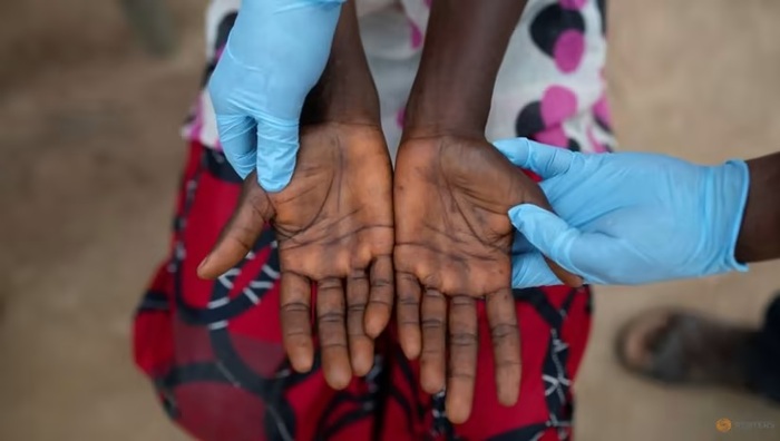 Một bệnh nhân bị mắc mpox/đậu mùa khỉ. Ảnh: Reuters