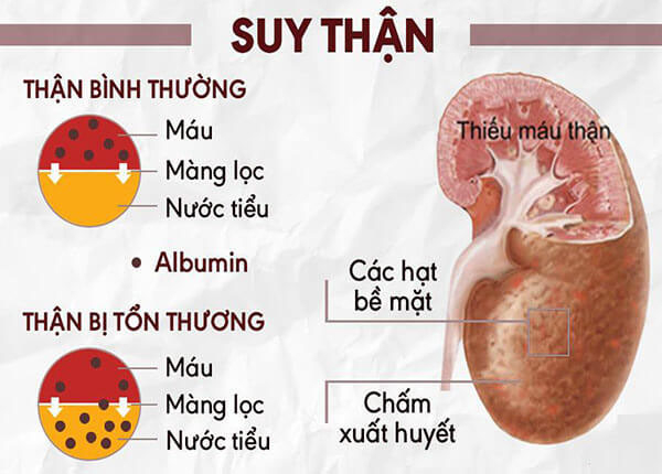 Suy thận tại thận là bệnh lý phổ biến, ảnh hưởng nghiêm trọng đến sức khỏe