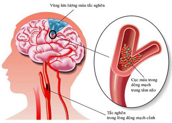 Đột quỵ còn được gọi là tai biến mạch máu não