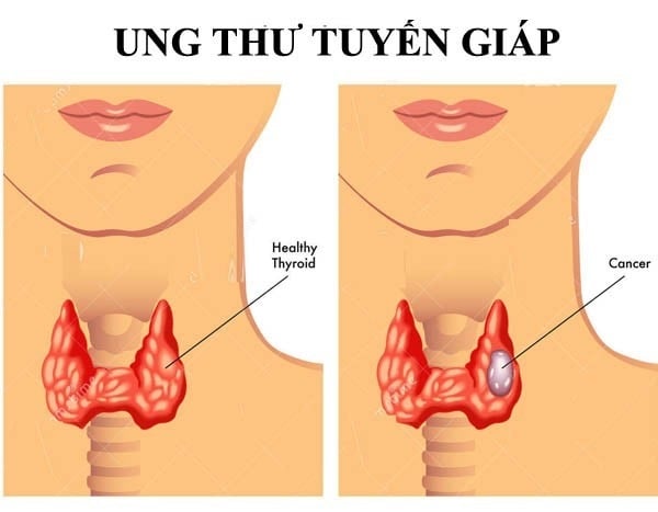 ung-thu-tuyen-giap-2-600x467-1531799874