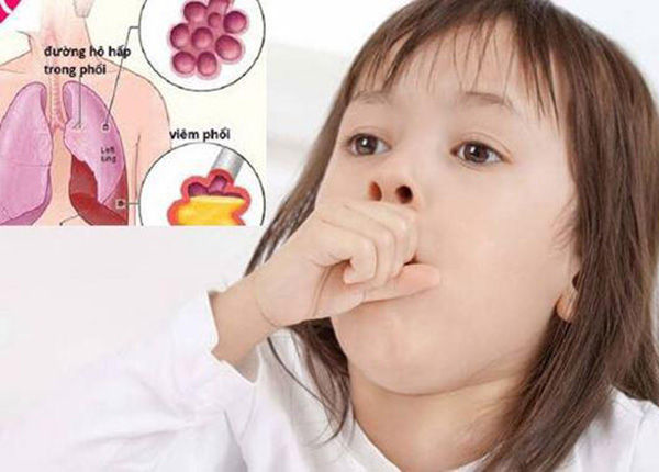 Viêm phổi trẻ em là bệnh thường gặp