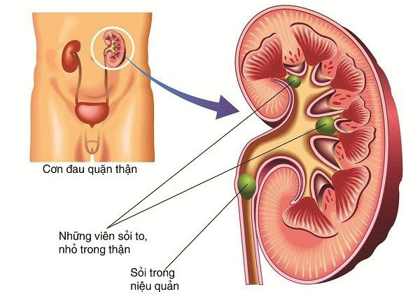 Sỏi tiết niệu là bệnh lý thường gặp nhất tại hệ tiết niệu