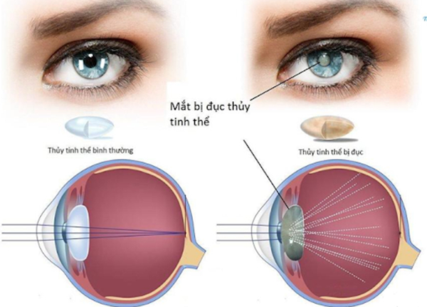 Mắt bình thường và mắt bị đục thủy tinh thể