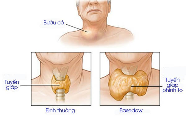 Bệnh Basedow là một rối loạn tự miễn dịch gây ra cường giáp