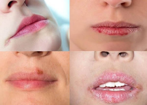 Chốc mép là bệnh phổ biến đặc biệt là ở trẻ nhỏ