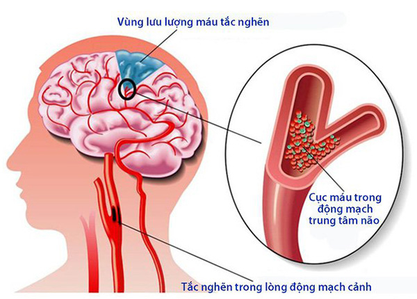 Tai biến mạch máu não nhẹ không nên bỏ qua