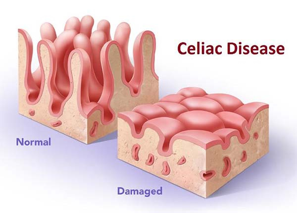 Bệnh celiac