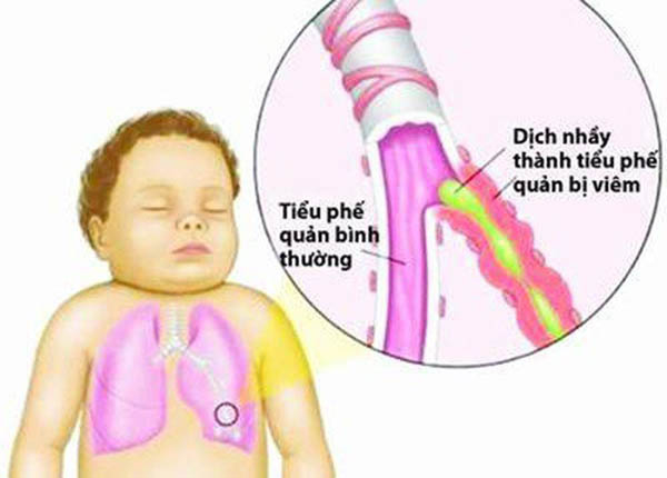 Hen phế quản ảnh hưởng tới đường thở của trẻ