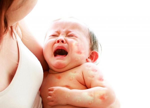 Trẻ em rất hay dễ mắc các bệnh dị ứng