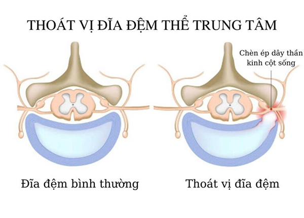 Có rất nhiều nguyên nhân gây nên tình trạng thoát vị đĩa đệm thể trung tâm