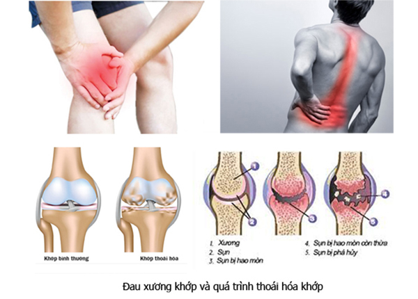 thoái hóa xương khớp