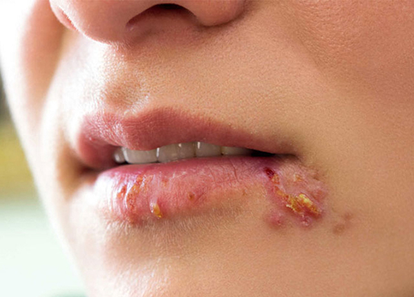 Chốc mép xảy ra quanh mép không chỉ gây khó chịu mà còn làm mất thẩm mỹ