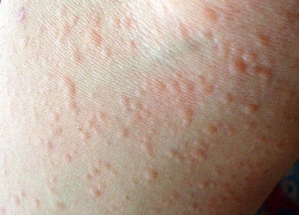 Dị ứng thời tiết khi thay đổi nhiệt độ đột ngột