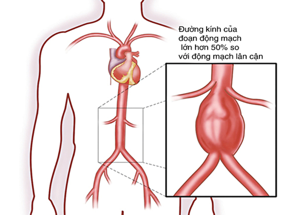 Phình động mạch chủ là một trong những căn bệnh khá phổ biến