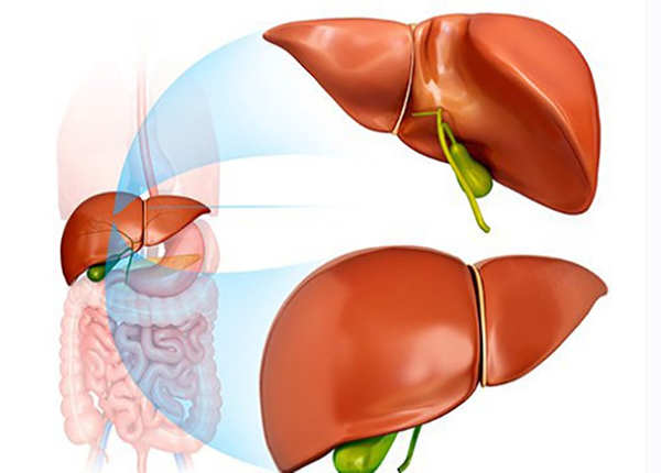 Viêm gan D hay còn gọi là viêm gan delta do virus viêm gan D (HDV) gây nên