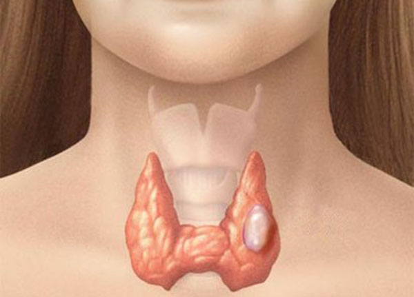 U tuyến giáp lành tính là bệnh lý phổ biến ở nữ giới