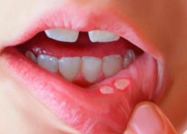 Vết nhiệt miệng điển hình
