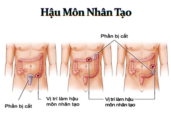 Vị trí tạo hậu môn nhân tạo Vị trí tạo hậu môn nhân tạo