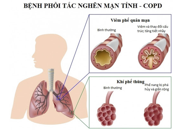 Bệnh phổi tắc nghẽn mãn tính (COPD) là bệnh phổ biến