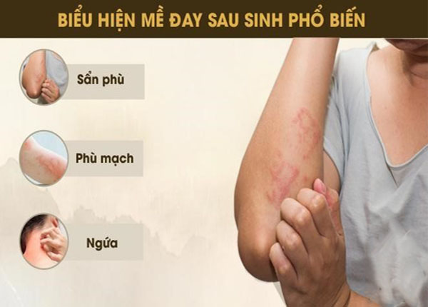 Phụ nữ bị nổi mề đay sau sinh mổ Phụ nữ bị nổi mề đay sau sinh mổ