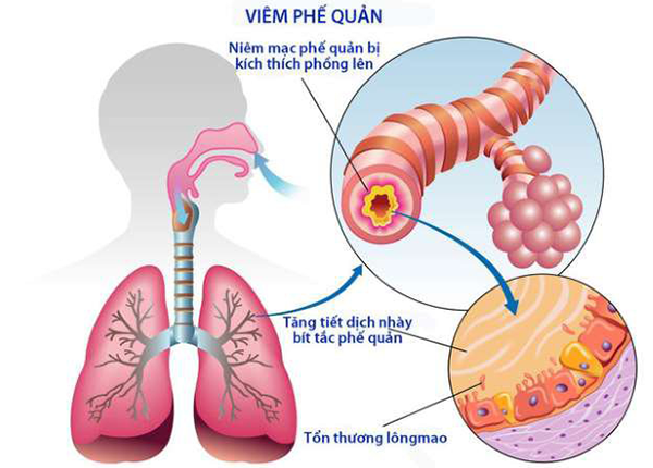 Bệnh viêm phế quản Bệnh viêm phế quản