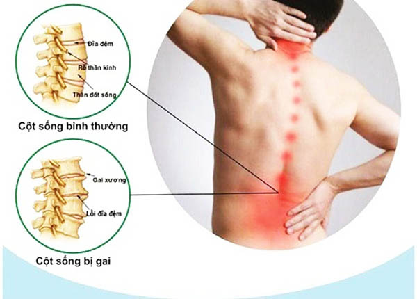 Bệnh gai cột sống Bệnh gai cột sống