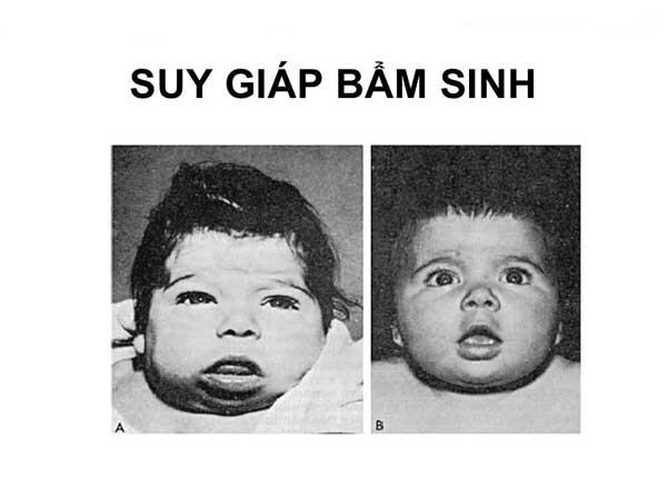 Suy giáp bẩm sinh là bệnh lý ảnh hưởng trực tiếp đến sự tăng trưởng, phát triển