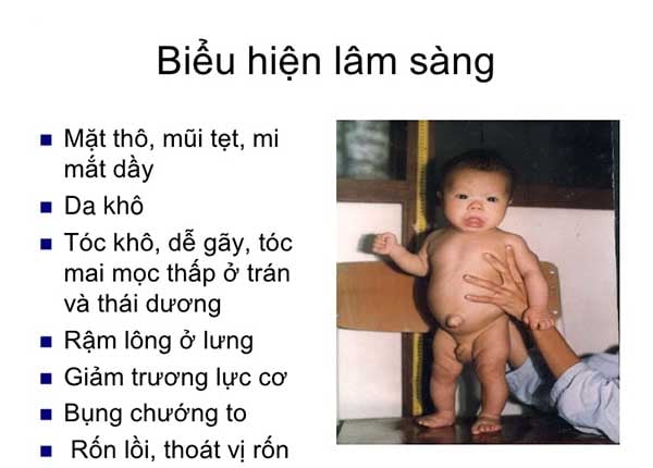 Đặc điểm trẻ bị suy giáp bẩm sinh là mũi tẹt, gẫy, lỗ mũi hếch, mặt tròn, môi và lưỡi dày,....