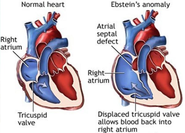 Bệnh Ebstein là một căn bệnh bẩm sinh rất hiếm gặp