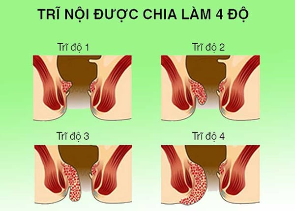 Bệnh trĩ nội được chia thành 4 cấp độ