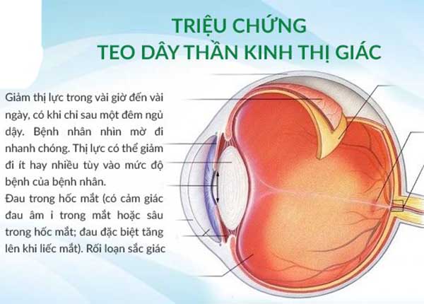 Triệu chứng khi bị bệnh teo dây thần kinh thị giác