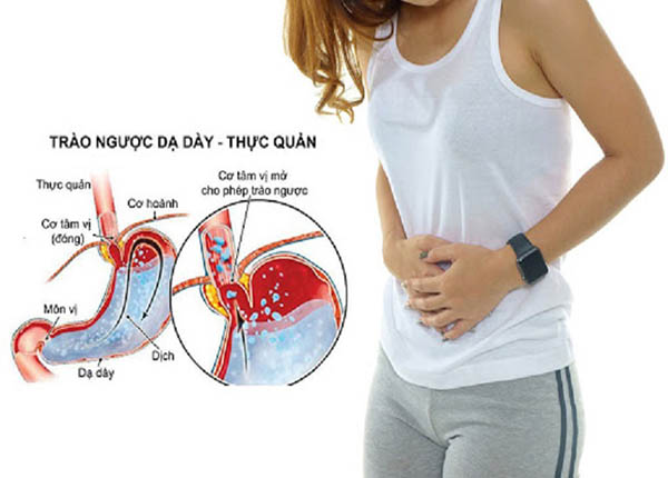 Trào ngược dịch vị dạ dày lên thực quản họng gọi tắt là trào ngược dạ dày