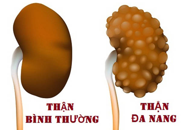 Tình trạng thận bình thường và thận đa nang