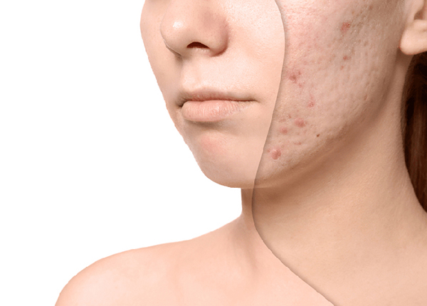 Sẹo do mụn trứng cá