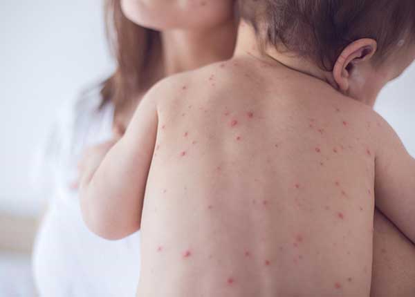 Ở giai đoạn khởi phát, người bệnh bắt đầu nổi ban đỏ, sốt cao và mệt mỏi
