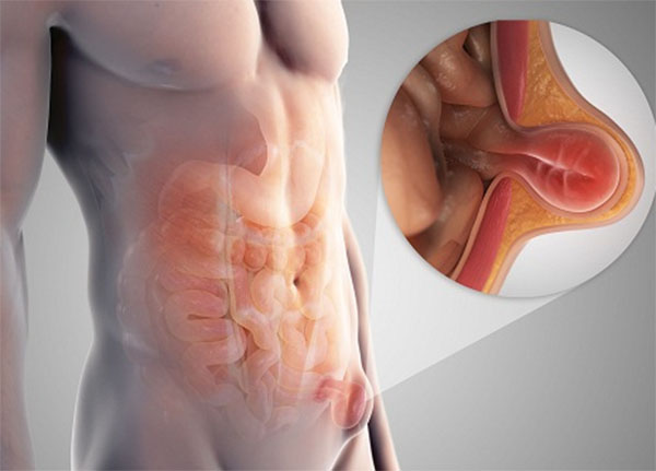 Thoát vị là tình trạng những túi phình của nội tạng hoặc mô bị trồi ra