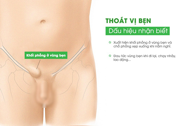 Tầm soát thoát vị bẹn để phát hiện, điều trị và chấm dứt hoàn toàn bệnh