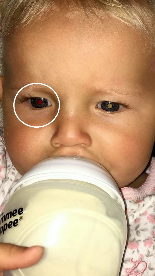 Bức ảnh chụp bé Felicity được mẹ bé chia sẻ trên Facebook cho thấy mắt phải của bé có những đốm phản chiếu khác thường