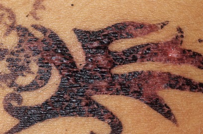 Một hình xăm Henna bị dị ứng nghiêm trọng - Nguồn: FDA