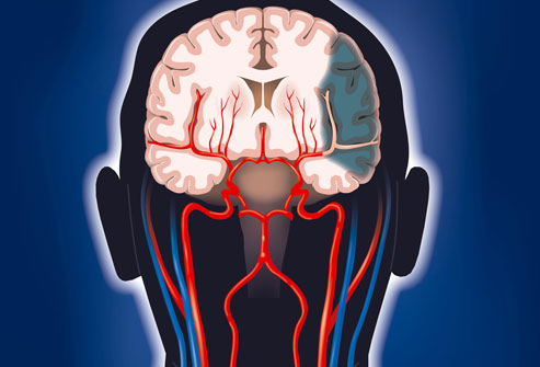 Tổn thương trong mạch mão não là nguyên nhân chính gây ra đột quỵ