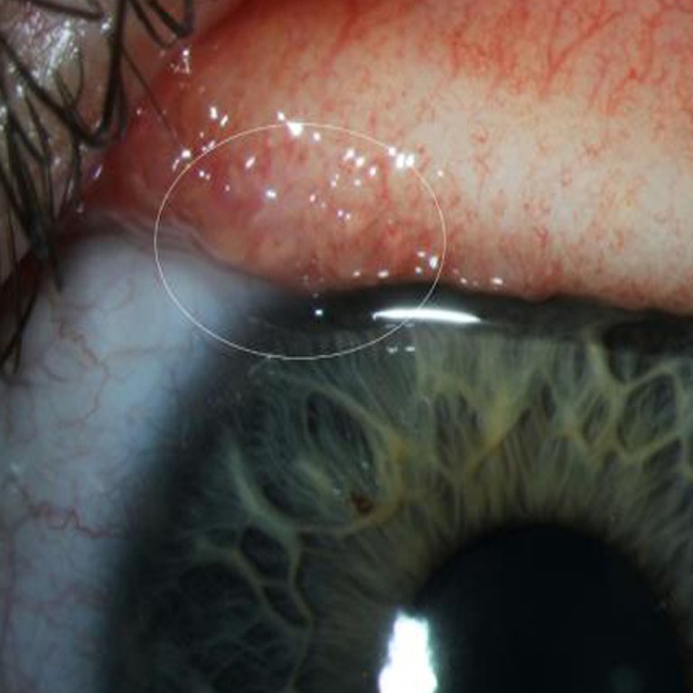 Một con giun trong mắt bệnh nhân Bekley